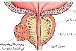 سرطان البروستاتا